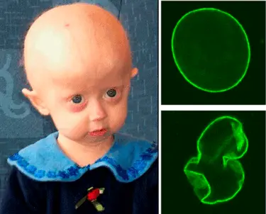 Progeria developmental disorder