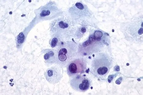 Pap stain to distinguish nucleus from cytoplasm